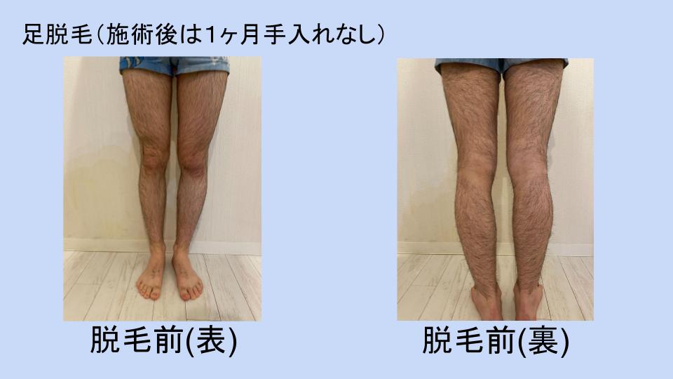 足脱毛（光脱毛）の経過・体験談・ビフォーアフター vol.2 | メンズ 